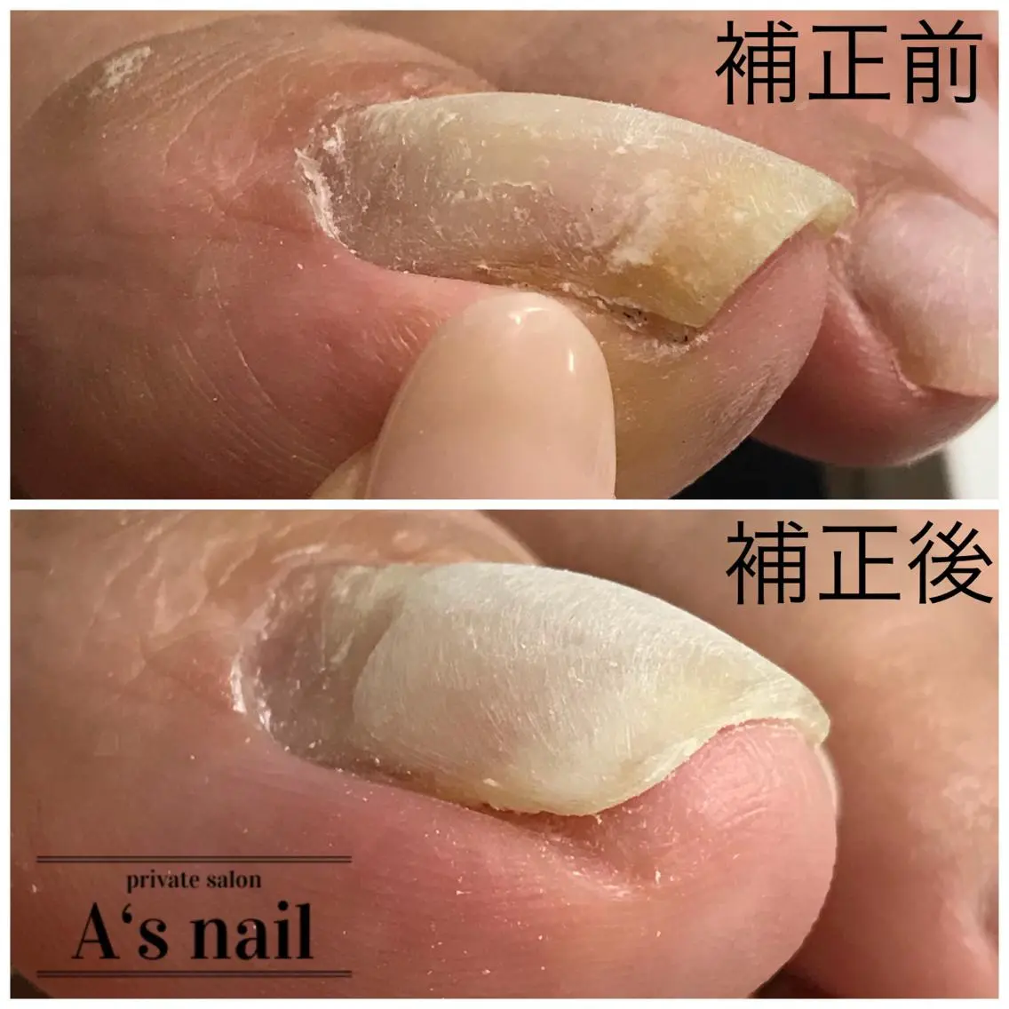 巻き爪補正全メニューセットの写真