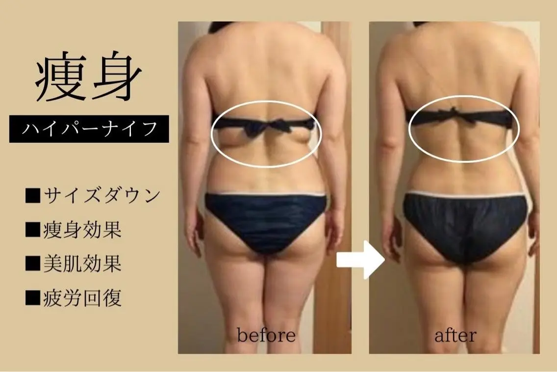 ≪特価★お腹二の腕背中≫ハイパーナイフ+ マッサージ60分¥ 13000→ ¥ 6800の写真