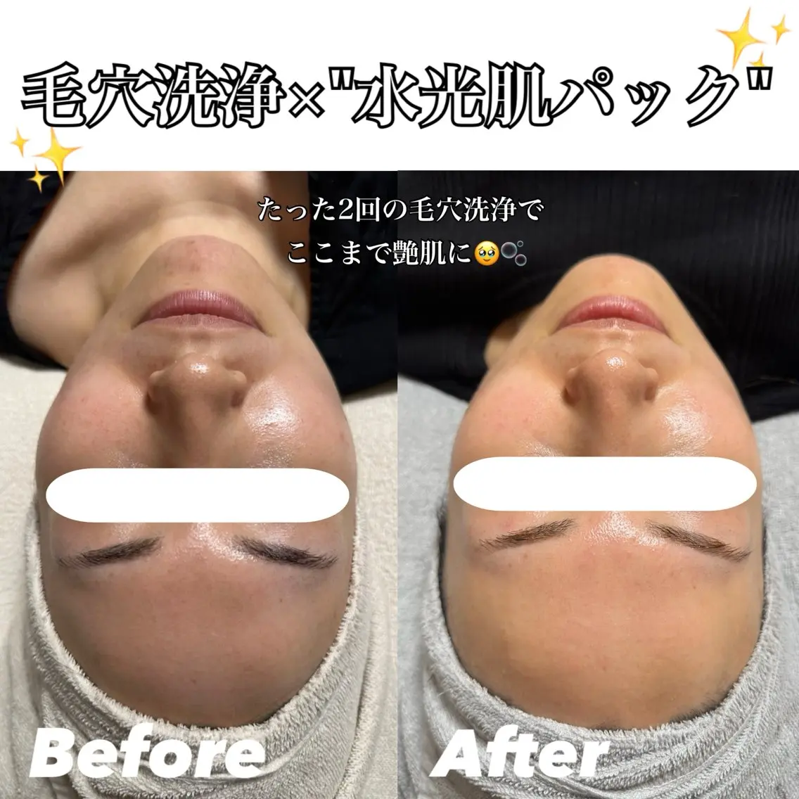 毛穴洗浄【艶&保湿・水光肌コース】(顔・首)の写真