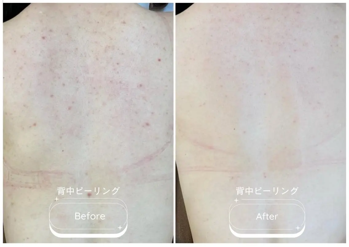 モニター募集🪡背中全体<7日間改善プログラム>剥離有ピーリング◎1週間で背中つるつる🫧ニキビ跡/ニキビ/色素沈着の写真