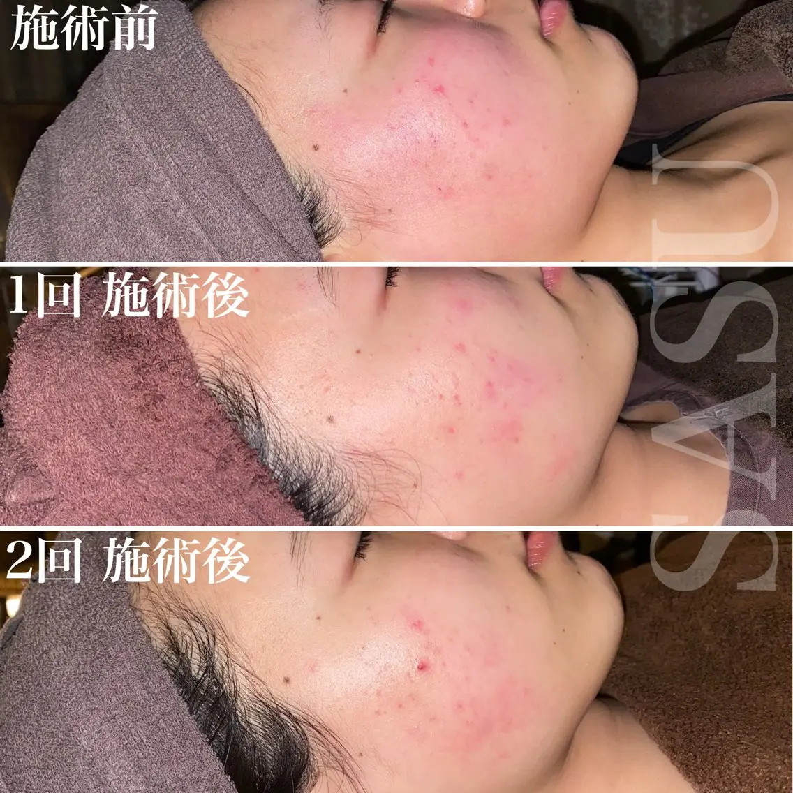 【ハーブピーリング🌿】シミ、そばかす、ニキビ跡、全部同時退治😊美容鍼or炭酸オプション各種¥1500で追加できますの写真