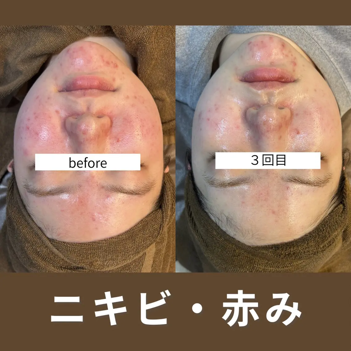 エステ ニキビ・ニキビ跡改善 leoloのエステ・リラクイメージ