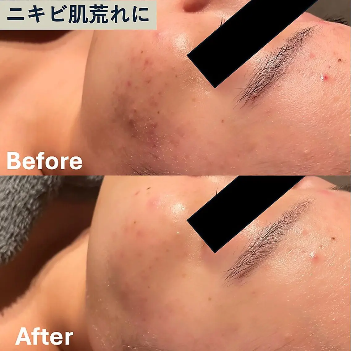 【肌荒れに】高濃度酸素注入+100%美容液導入でトラブルレスな肌へ🫧の写真