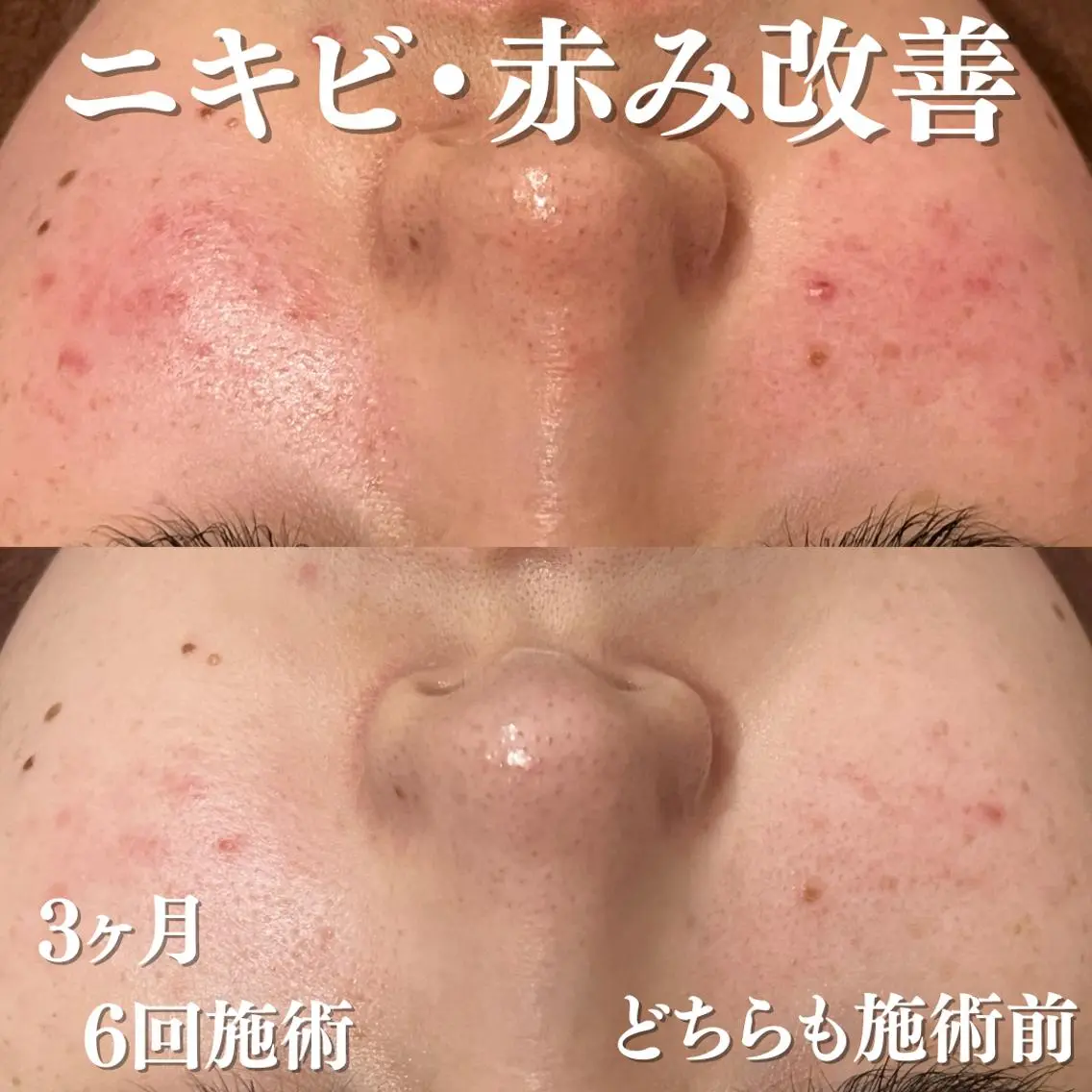 エステ リラク 3か月で肌革命👼 ニキビ専門店💫のエステ・リラクイメージ
