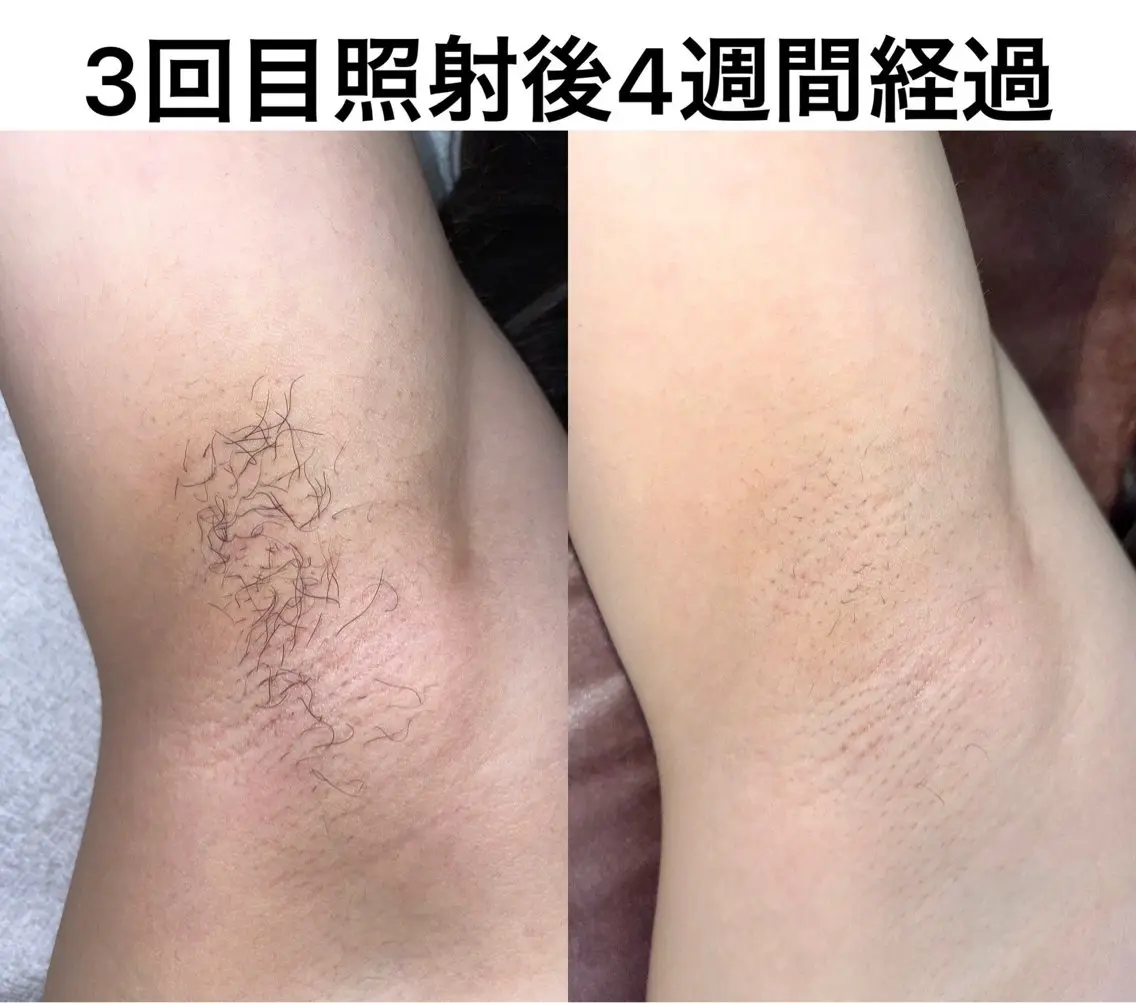 【本格脱毛】 グレイスフルルームのエステ・リラクイメージ