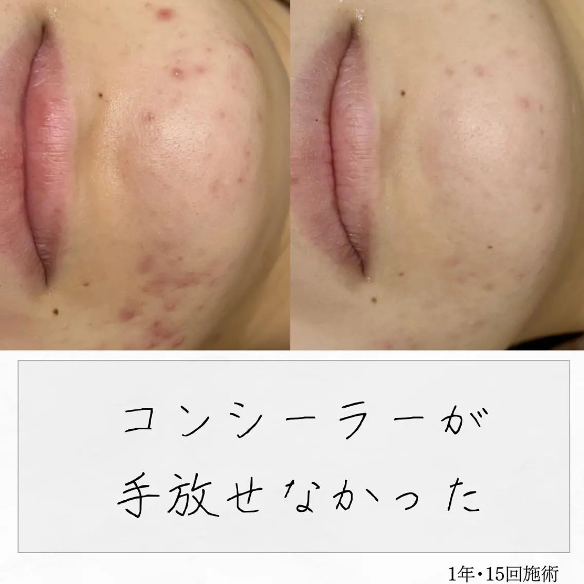 ニキビ経験者が施術 する専門サロン🌻のエステ・リラクイメージ