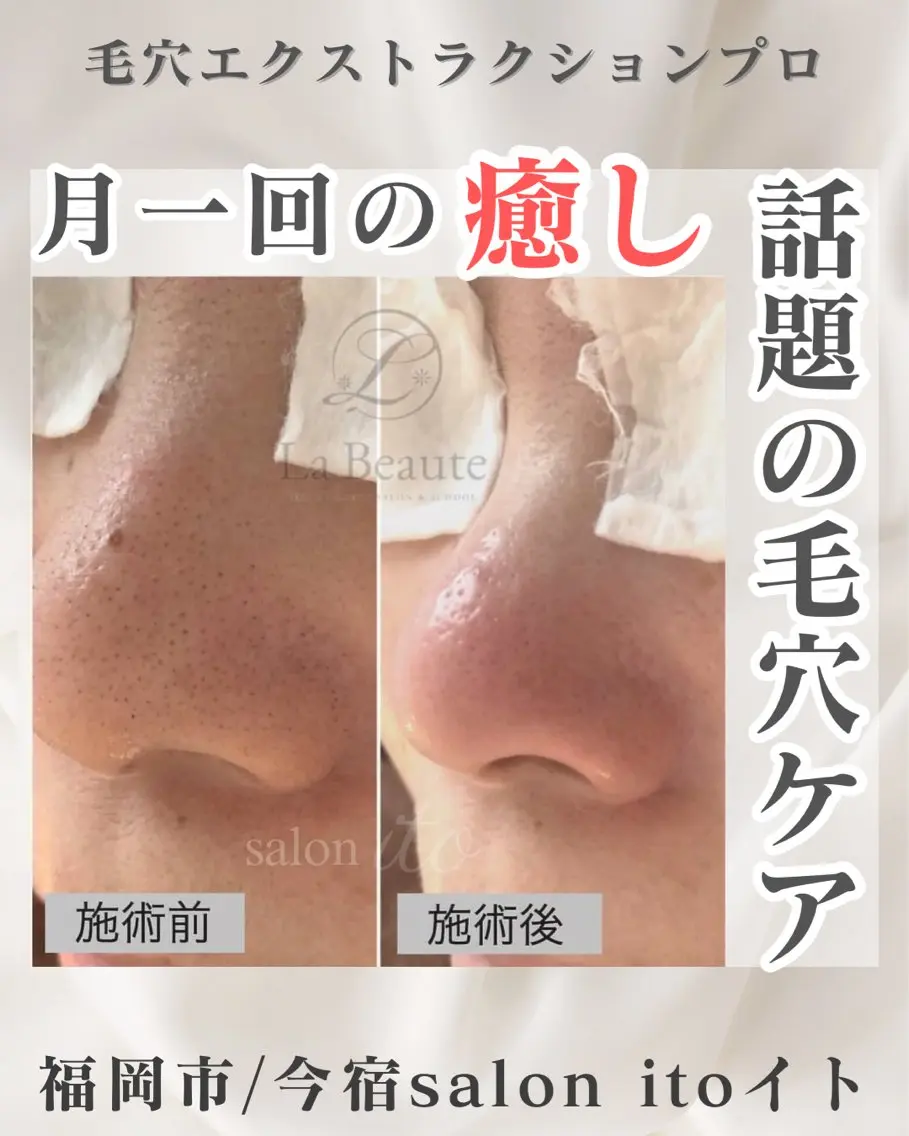 毛穴ベーシック　60.分(カウンセリングなども含めて、+30分) 約2時間のお時間ですの写真