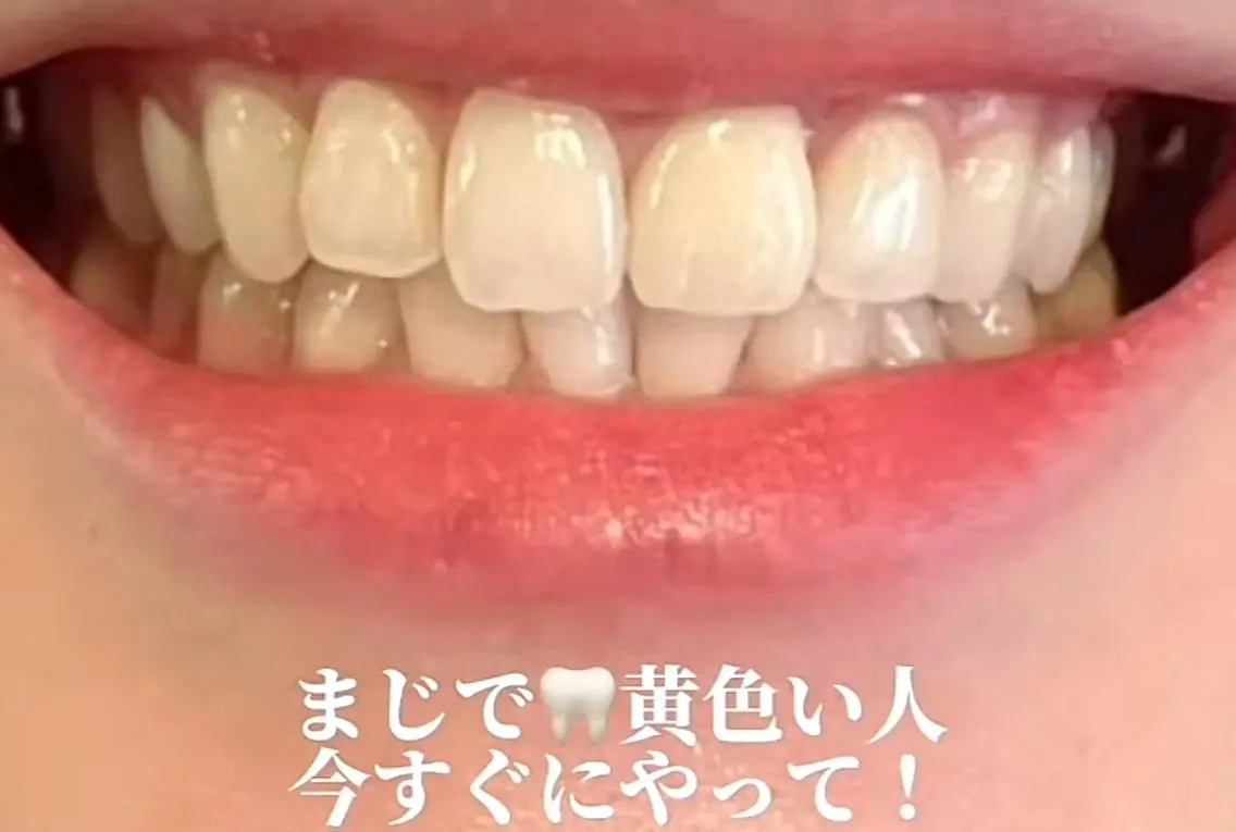 🎀歯の黄ばみ撃退！🎀新メニュー‼️ホワイトニング美意識高めの方の写真