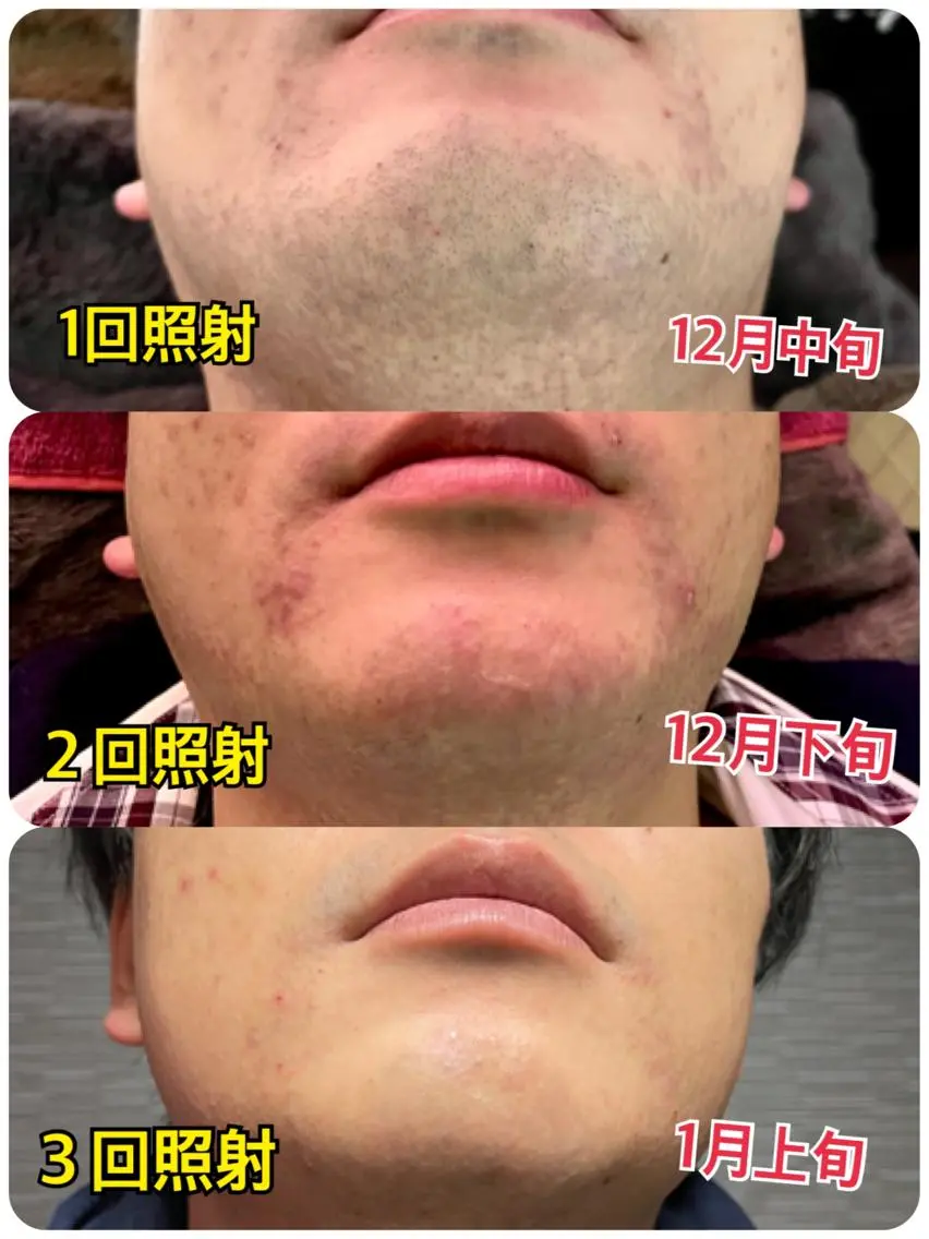 ヒゲ脱毛の写真