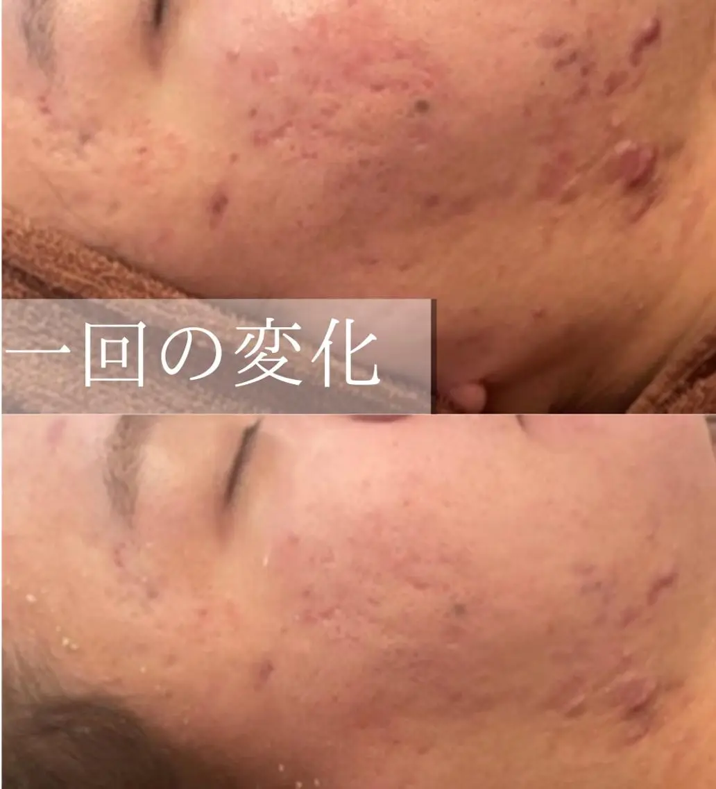 ロング カラー パーマ ヘアアレンジ メンズ キッズ ネイル マツエク・マツパ アイブロウ 3か月で肌革命👼 ニキビ専門店💫のエステ・リラクイメージ