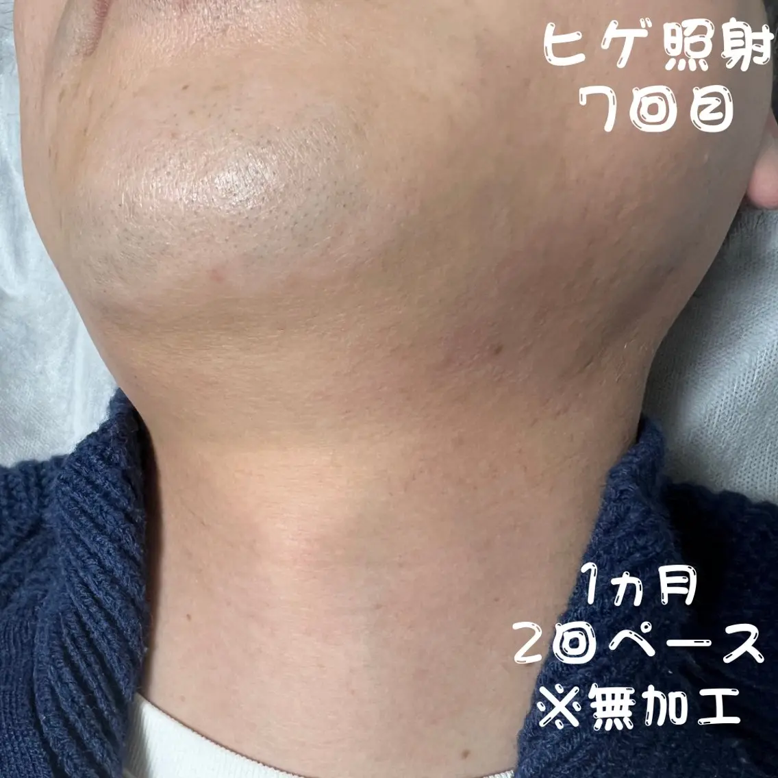 メンズ キッズ 脱毛 メンズ脱毛フェリッセ /男女🆗キッズ🆗のエステ・リラクイメージ