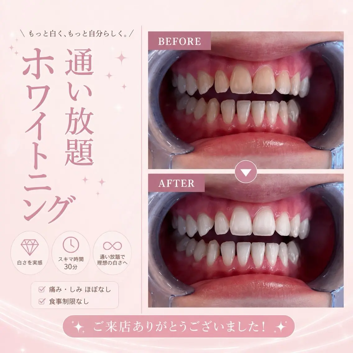 【定額⟡通い放題】🪞ᩚセルフホワイトニング ¥11,000/月の写真