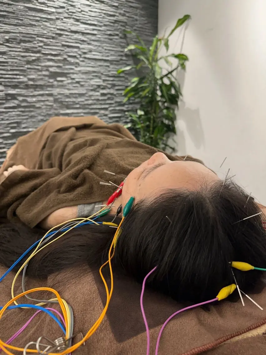 その他 小顔矯/美容鍼/鍼灸 BeauJuのその他イメージ