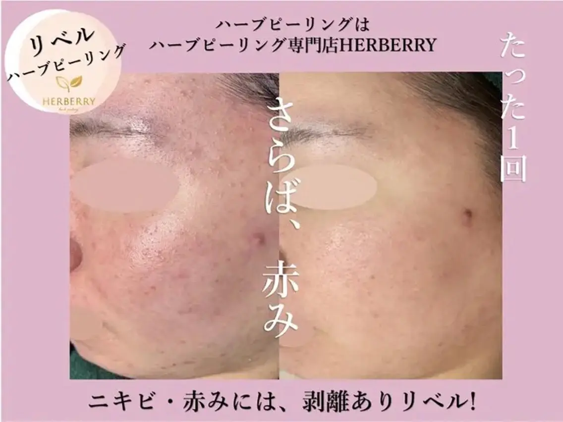 ハーブピーリング専門 HERBERRY冨永のエステ・リラクイメージ