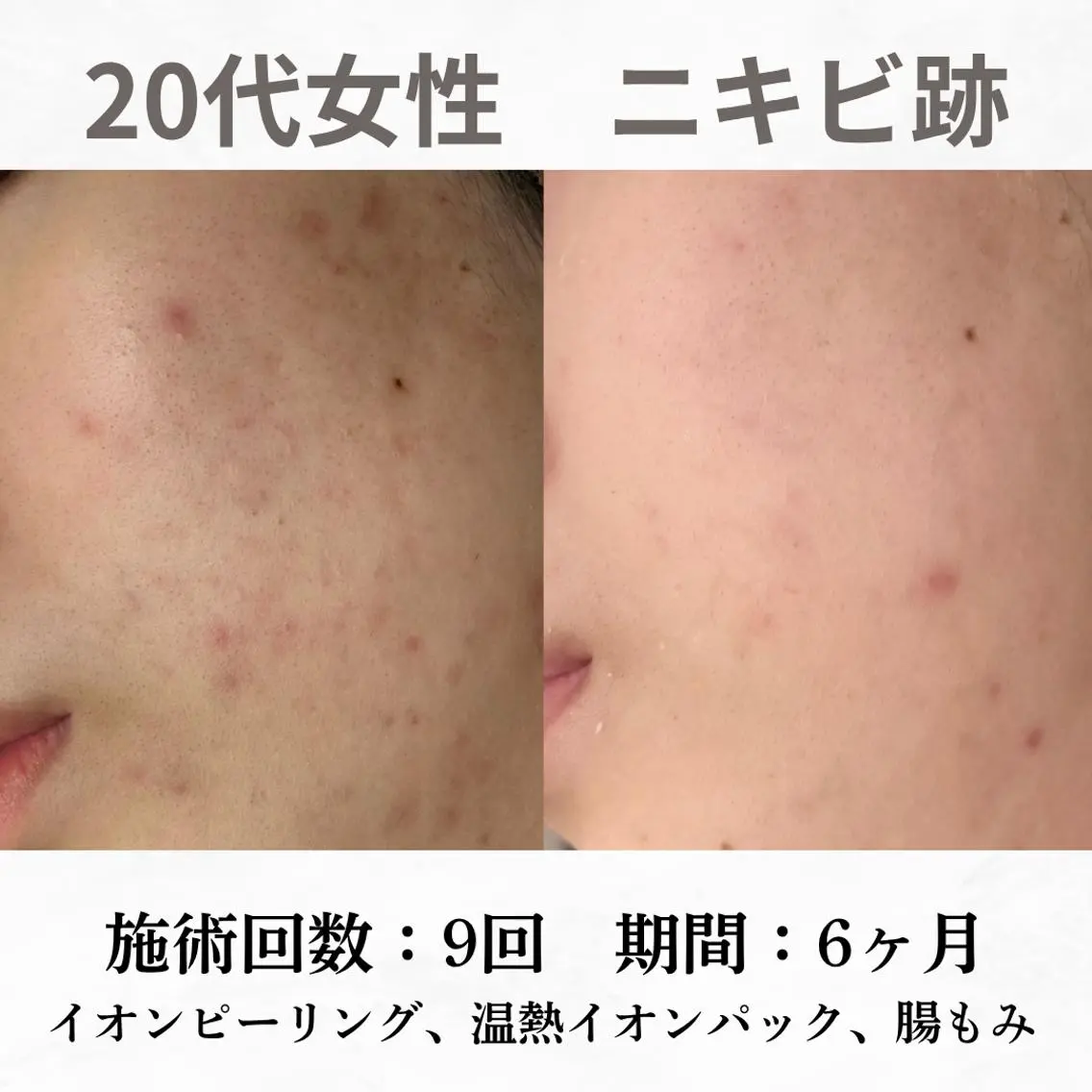 重度ニキビ専門🌷 ダウンタイムなしのエステ・リラクイメージ