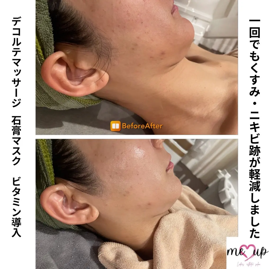 Meupニキビ専門店 背中/ハーブ/肌管理のその他イメージ
