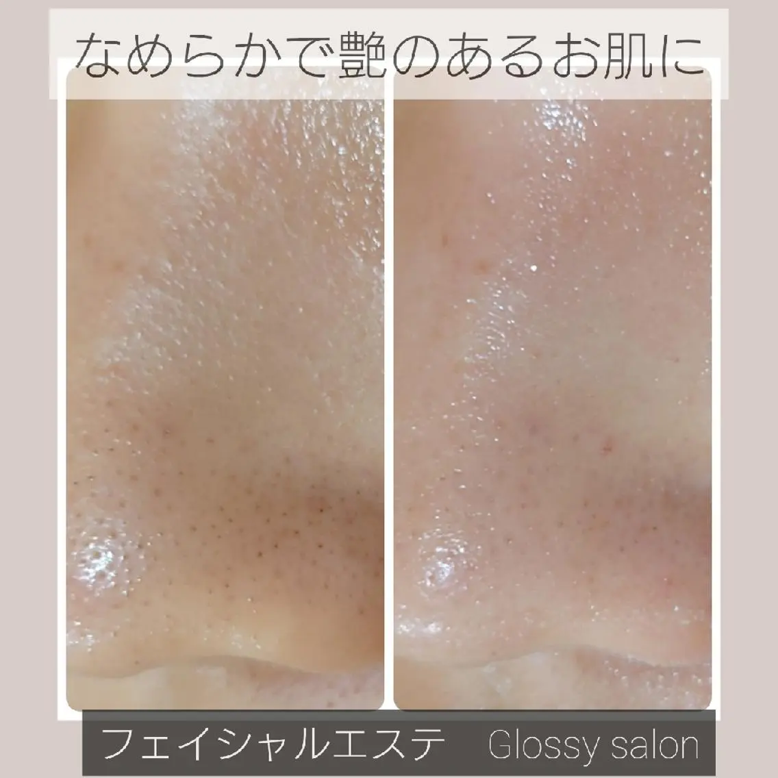 【美小顔術リフト】引き締まった小顔にの写真