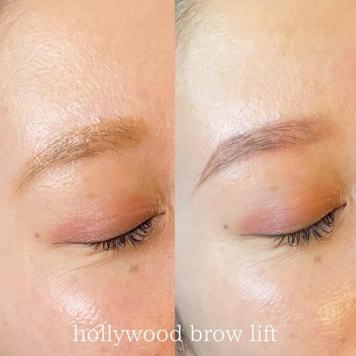 hollywood brow liftの写真