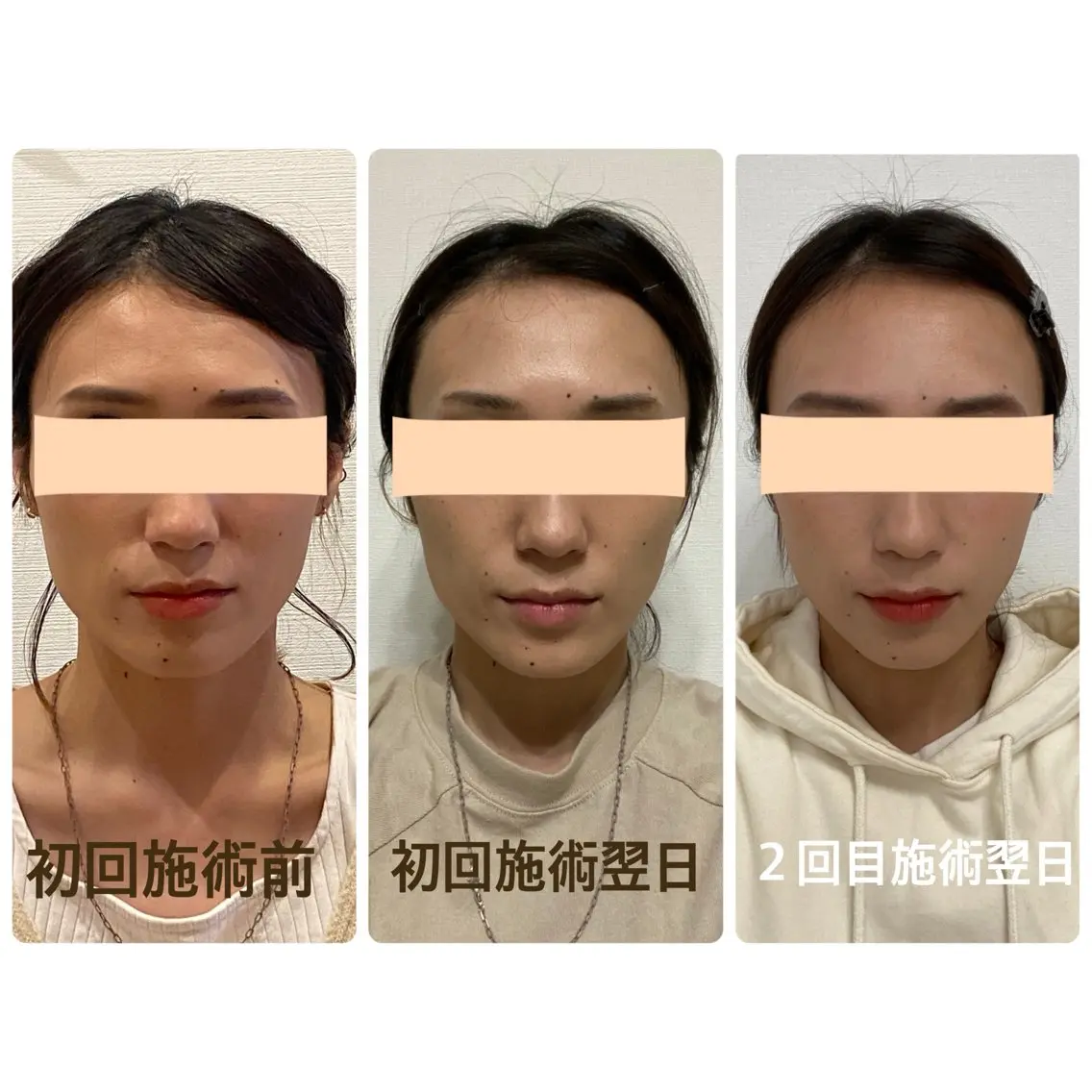 小顔矯正の写真