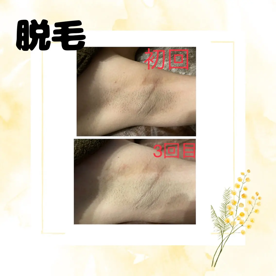 全身脱毛(顔&VIO込)クレンジング洗顔込み/通常価格¥23,000→円11,000の写真