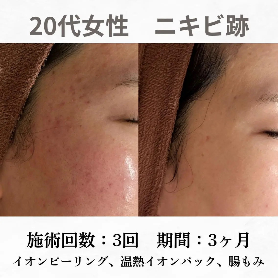 重度ニキビ専門🌷 ダウンタイムなしのエステ・リラクイメージ