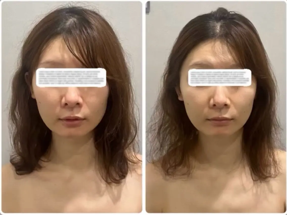 24歳以下限定!【小顔・肩こり】小顔矯正ヘッドスパ+腕肩のオイルマッサージの写真