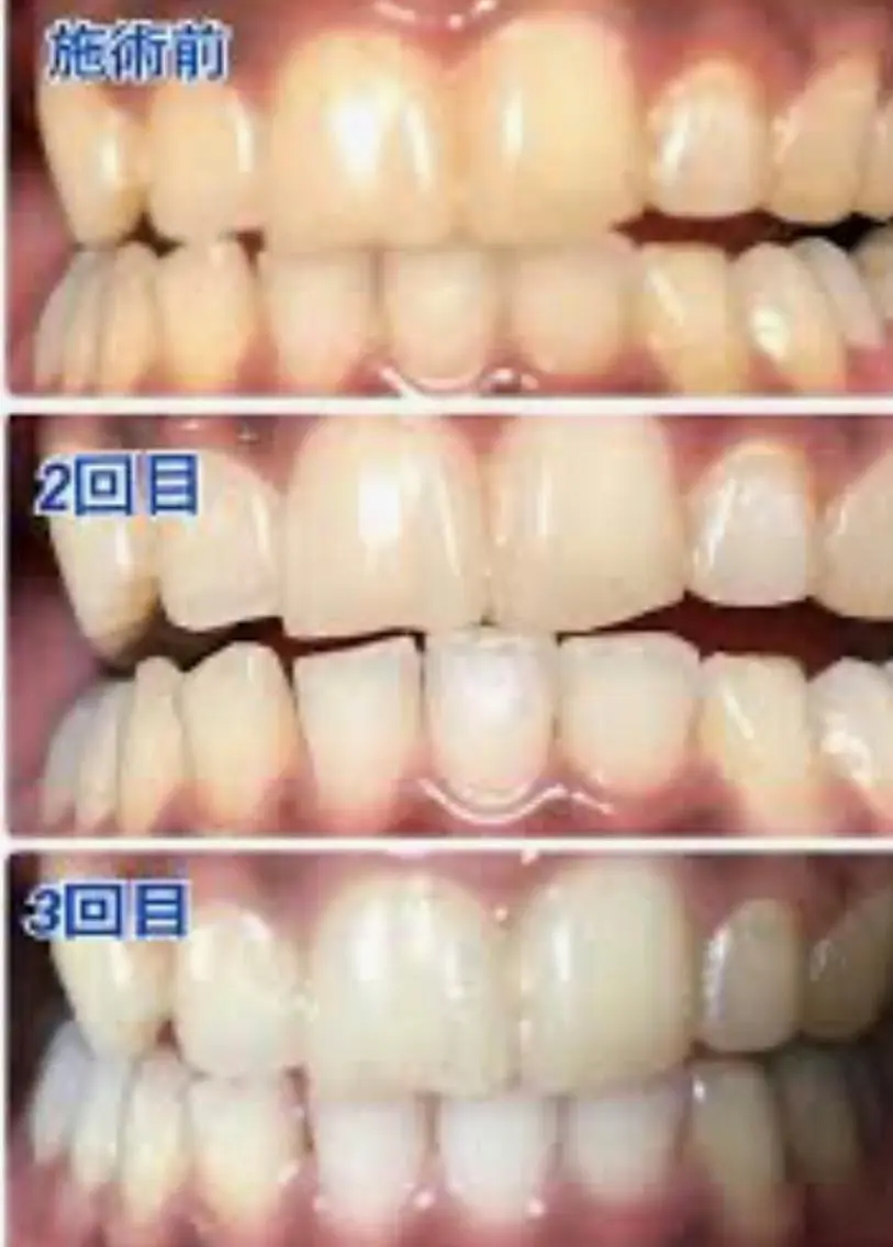 驚きの早さと効果🦷ホワイトニング3回4000円💫の写真