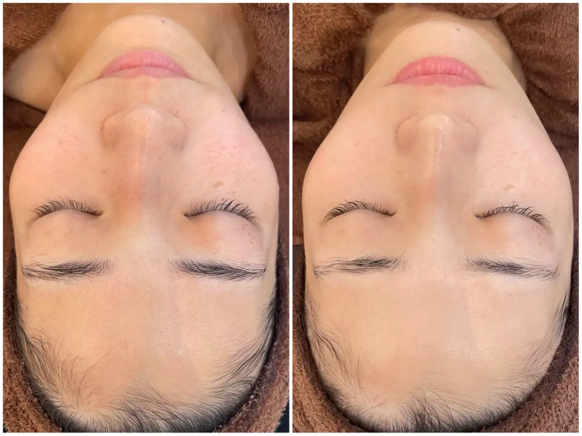 【針を使わない導入ケア】高濃度ビタミンC✨透明感のある肌印象への写真