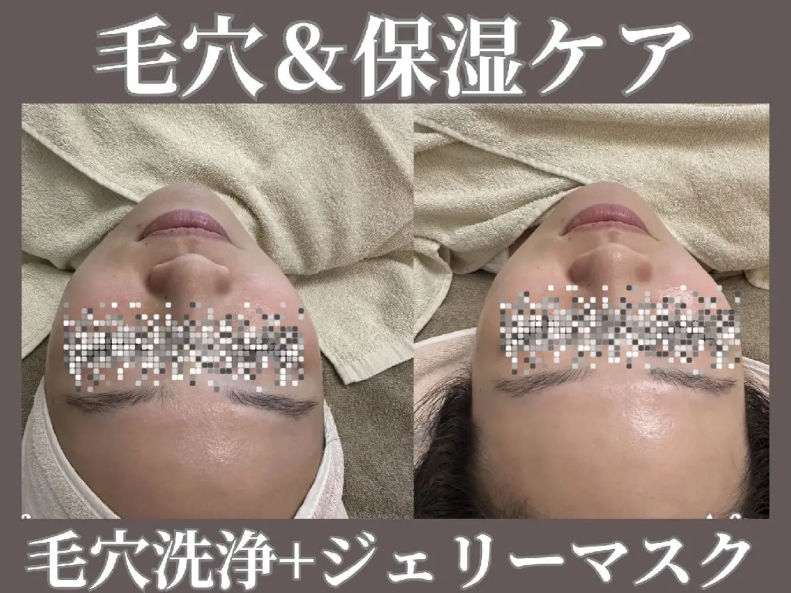 角栓/黒ずみ/皮脂汚れ撃退&白玉肌! 毛穴洗浄+ジェルパック ¥17600→¥7700の写真