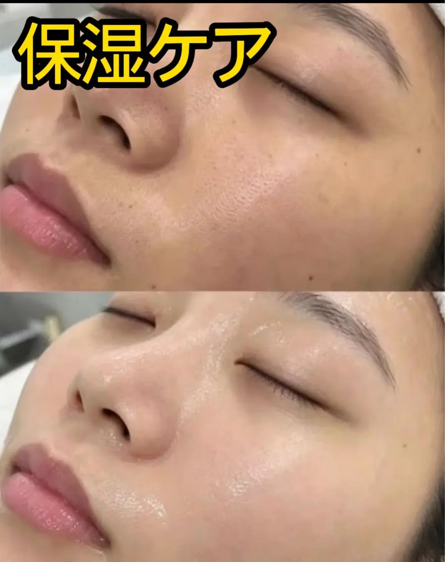 人気💕保湿ケア潤い肌へ💕毛穴洗浄とピーリング込み💕60分¥ 2980の写真