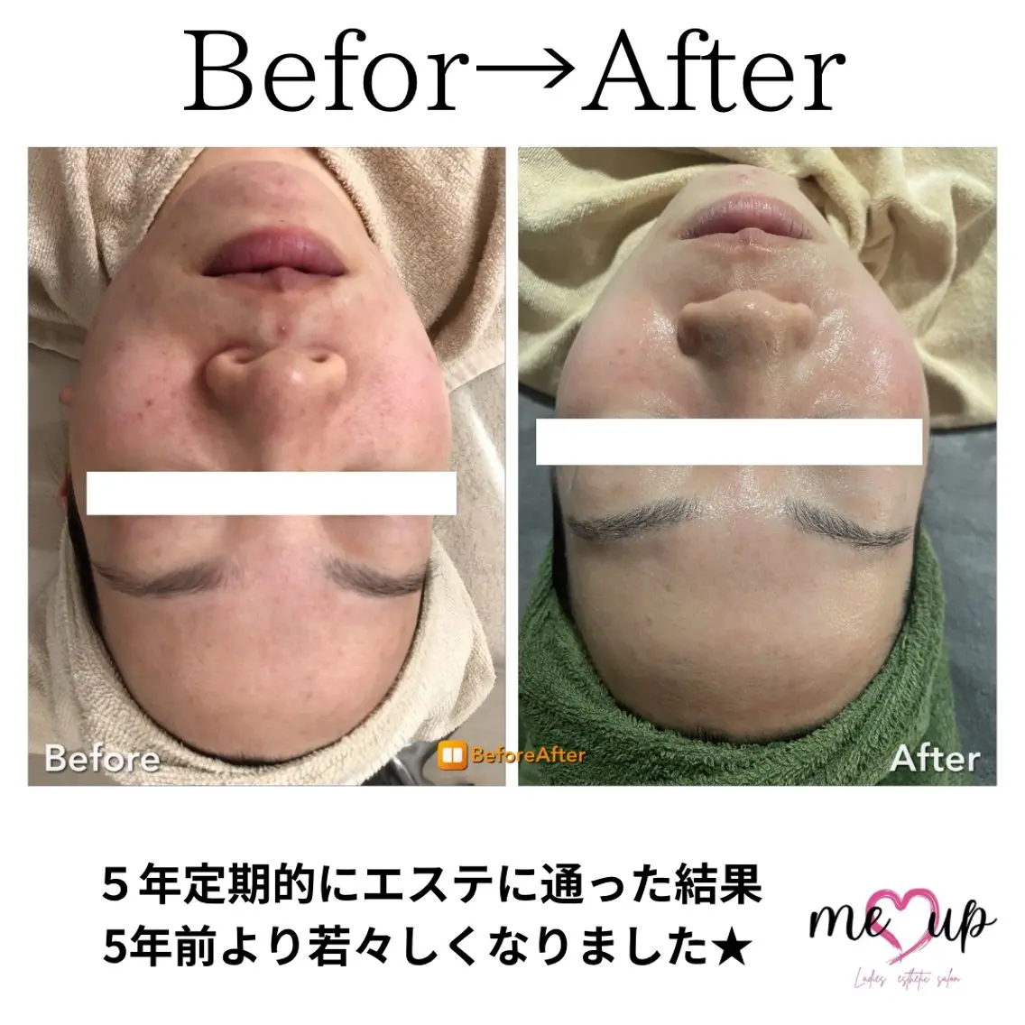 Meupニキビ専門店 背中/ハーブ/肌管理のその他イメージ
