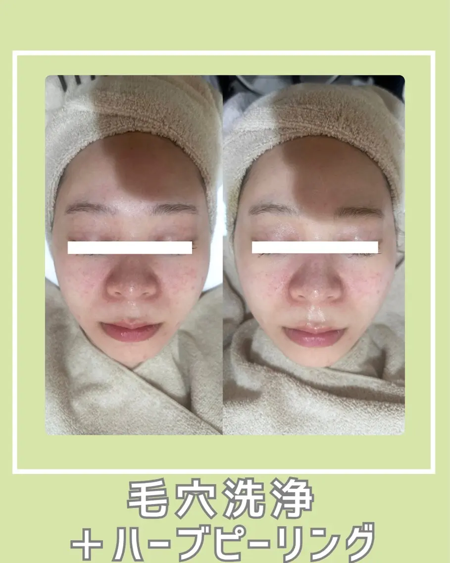〈毛穴悩みに👃〉毛穴洗浄+ハーブピーリング(ダウンタイム&剥離なし) 70分14,000円の写真