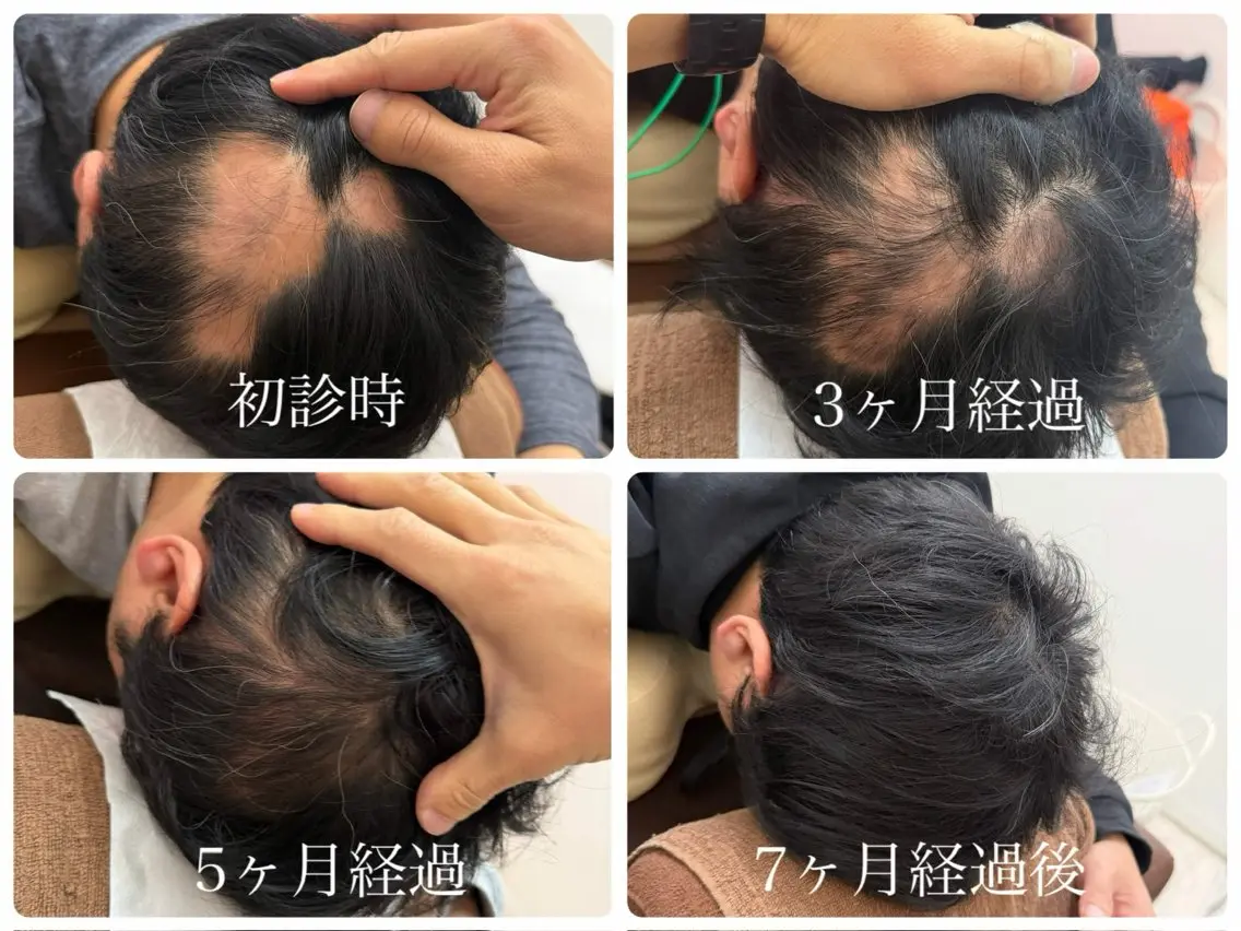 【人気NO.1】月3名限定カウンセリング& 初回体験 育毛促進鍼27500円→4980円/抜け毛/薄毛/細毛/円形脱毛症の写真