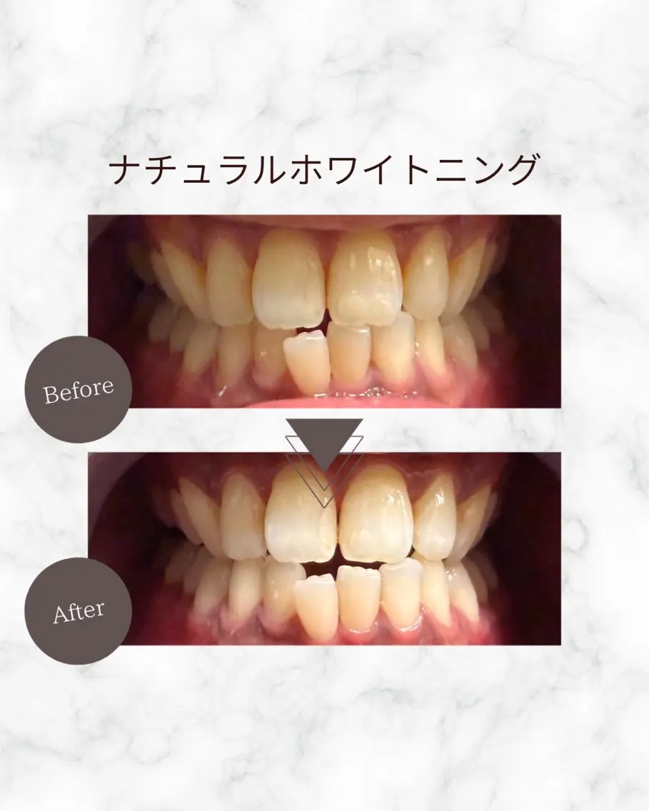セルフホワイトニング PAOのその他イメージ