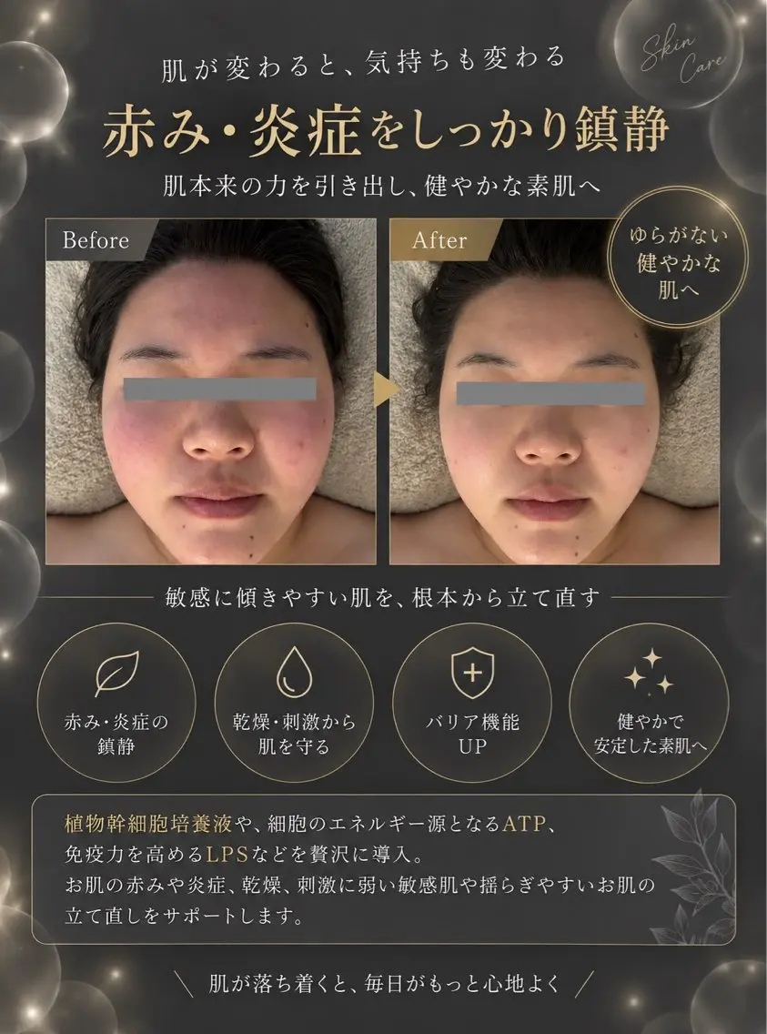 即日赤み鎮静！もち肌幹細胞トリートメントの写真