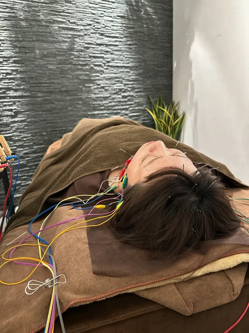 その他 小顔矯/美容鍼/鍼灸 BeauJuのその他イメージ