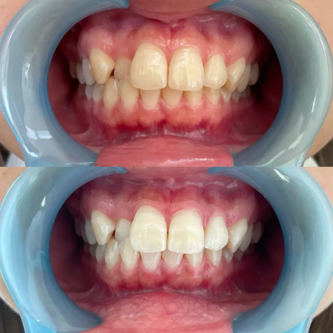 セルフホワイトニング🦷［初回限定 15分×2回コース］の写真