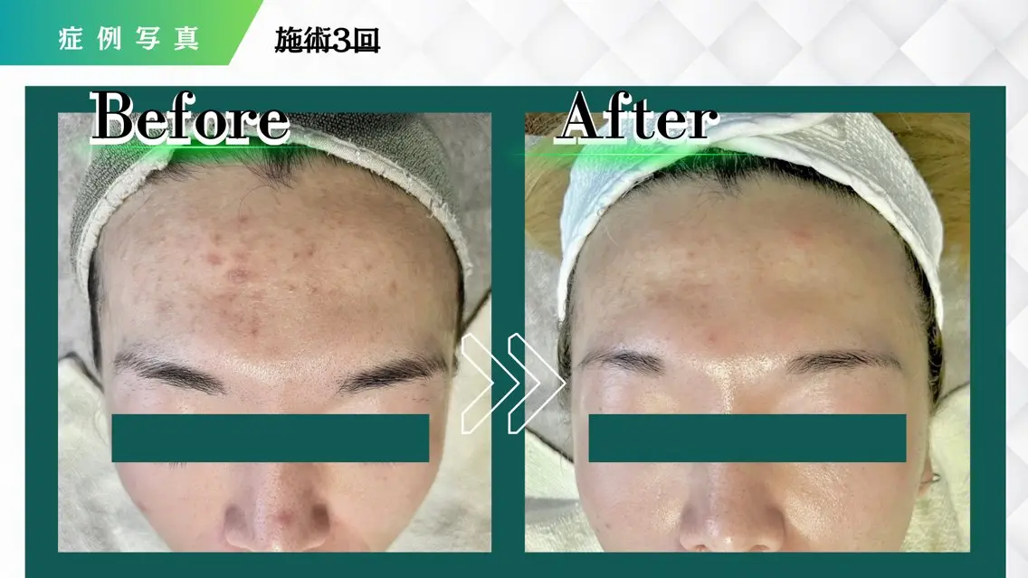 【5名様限定人気No1★医師推奨/本格肌改善】幹細胞入りの独自のハーブピーリング 赤ちゃん👶肌へ 毛穴レスのお肌に!の写真