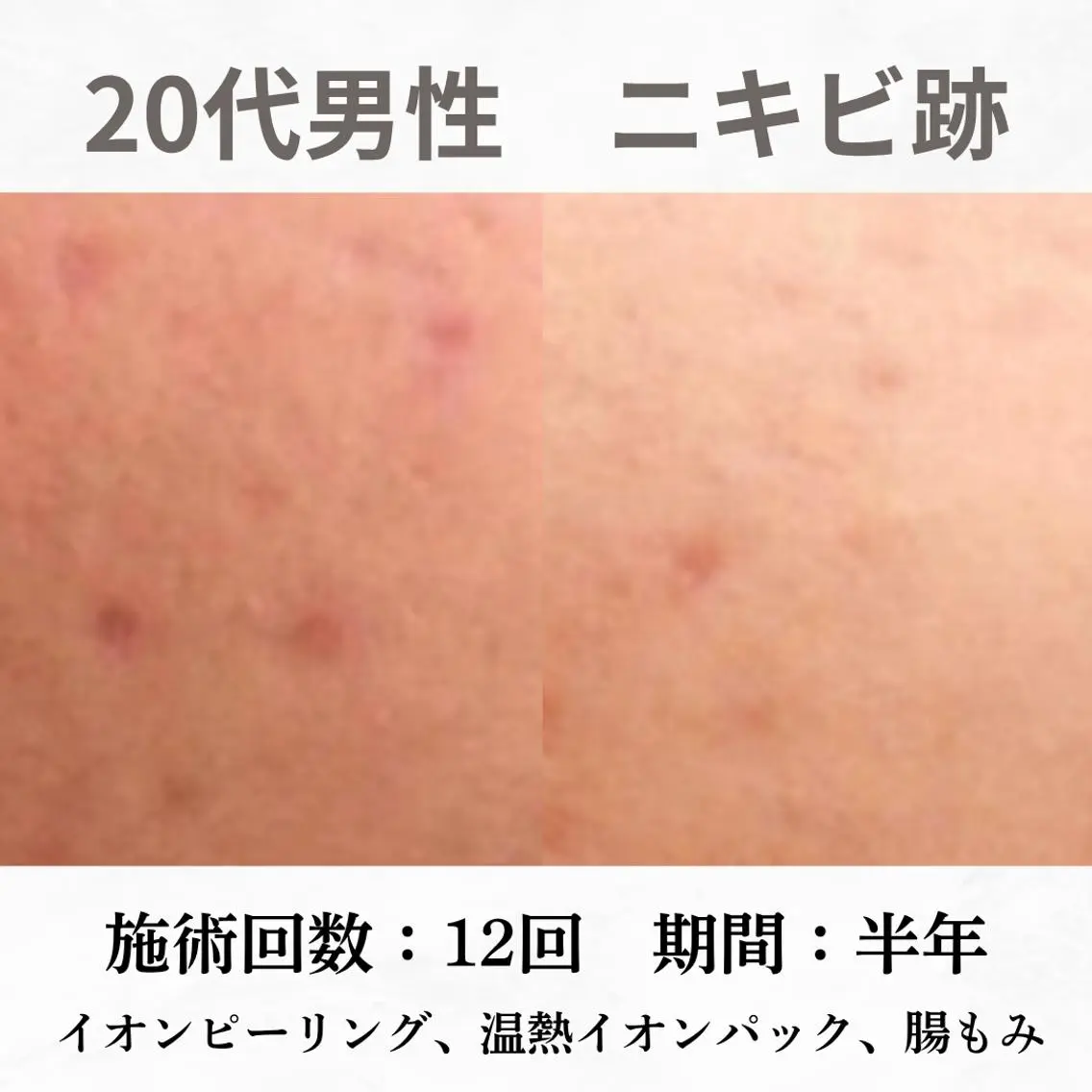重度ニキビ専門🌷 ダウンタイムなしのエステ・リラクイメージ