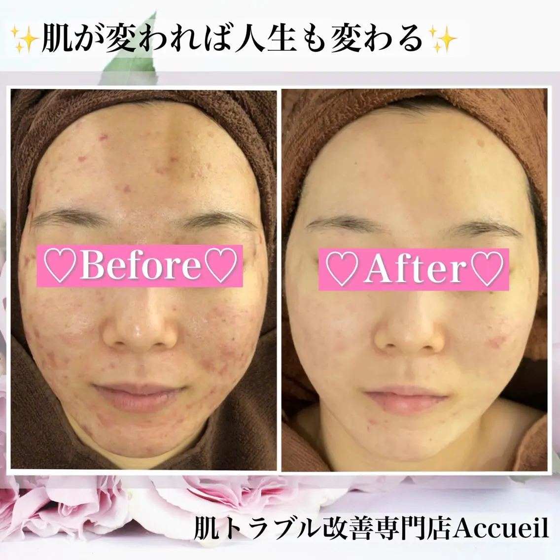 ミディアム カラー パーマ ヘアアレンジ メンズ キッズ ネイル マツエク・マツパ アイブロウ エステ リラク ニキビ・肌質改善専門 ♡人生が変わるサロンのエステ・リラクイメージ