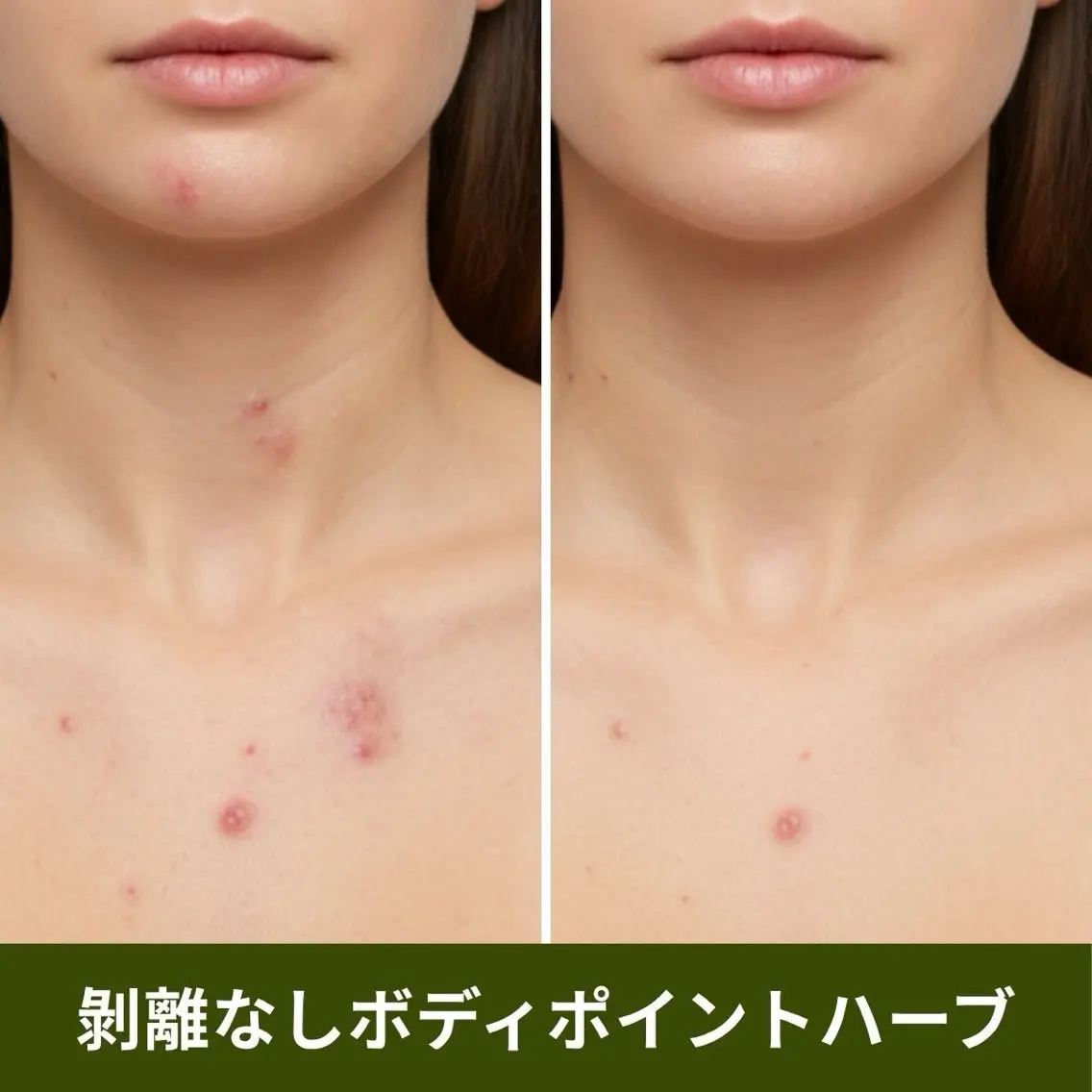 【ポイント施術】ボディハーブピーリング(剥離なし)ヒト幹細胞培養上清液入りハーブ🌿お尻/背中上or下/デコルテ/足/腕の写真