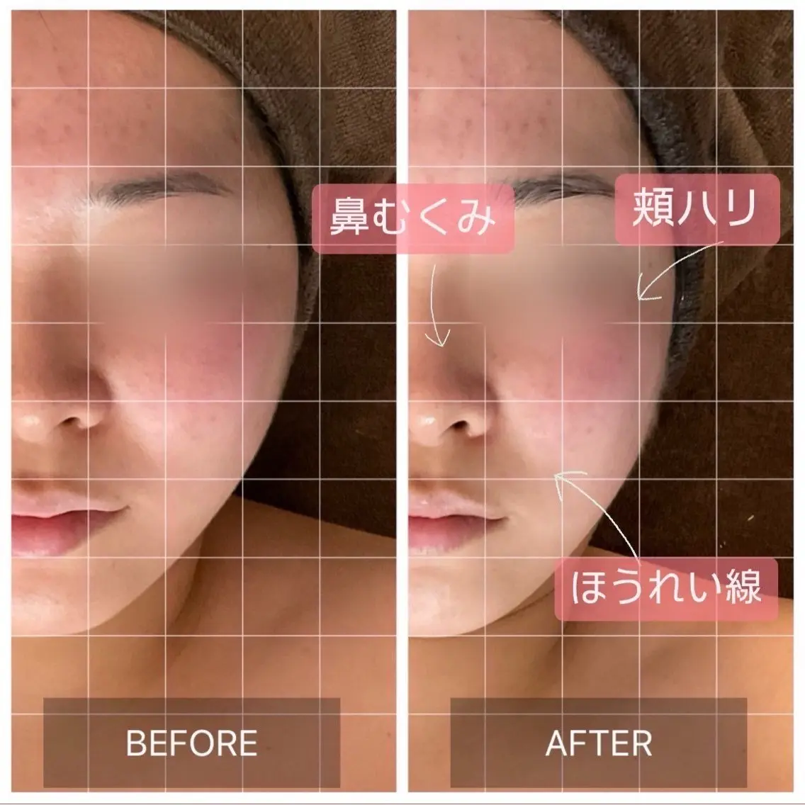 【美顔・姿勢改善ケア80min】首肩コリが辛い方はコレ‼️の写真