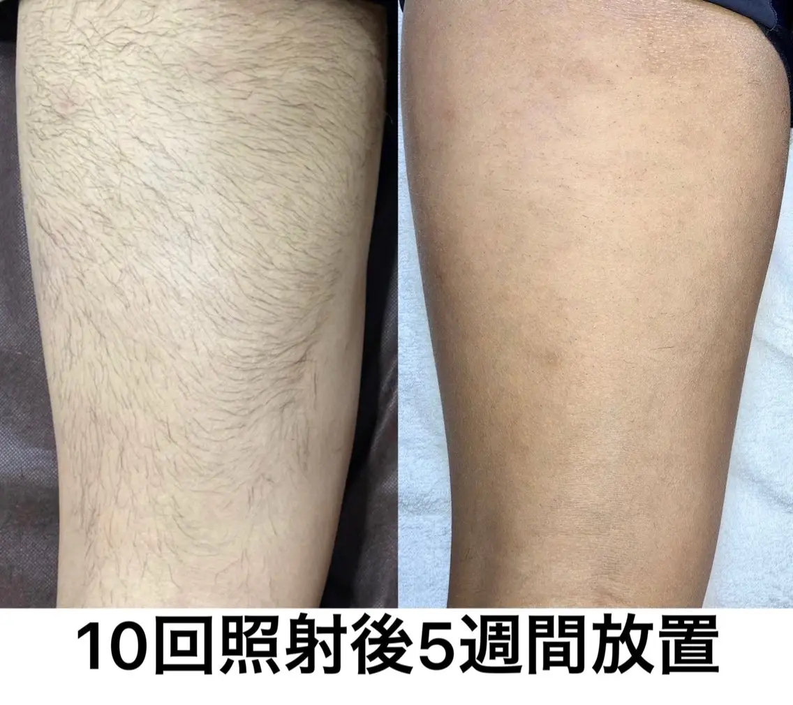 【本格脱毛】 グレイスフルルームのエステ・リラクイメージ