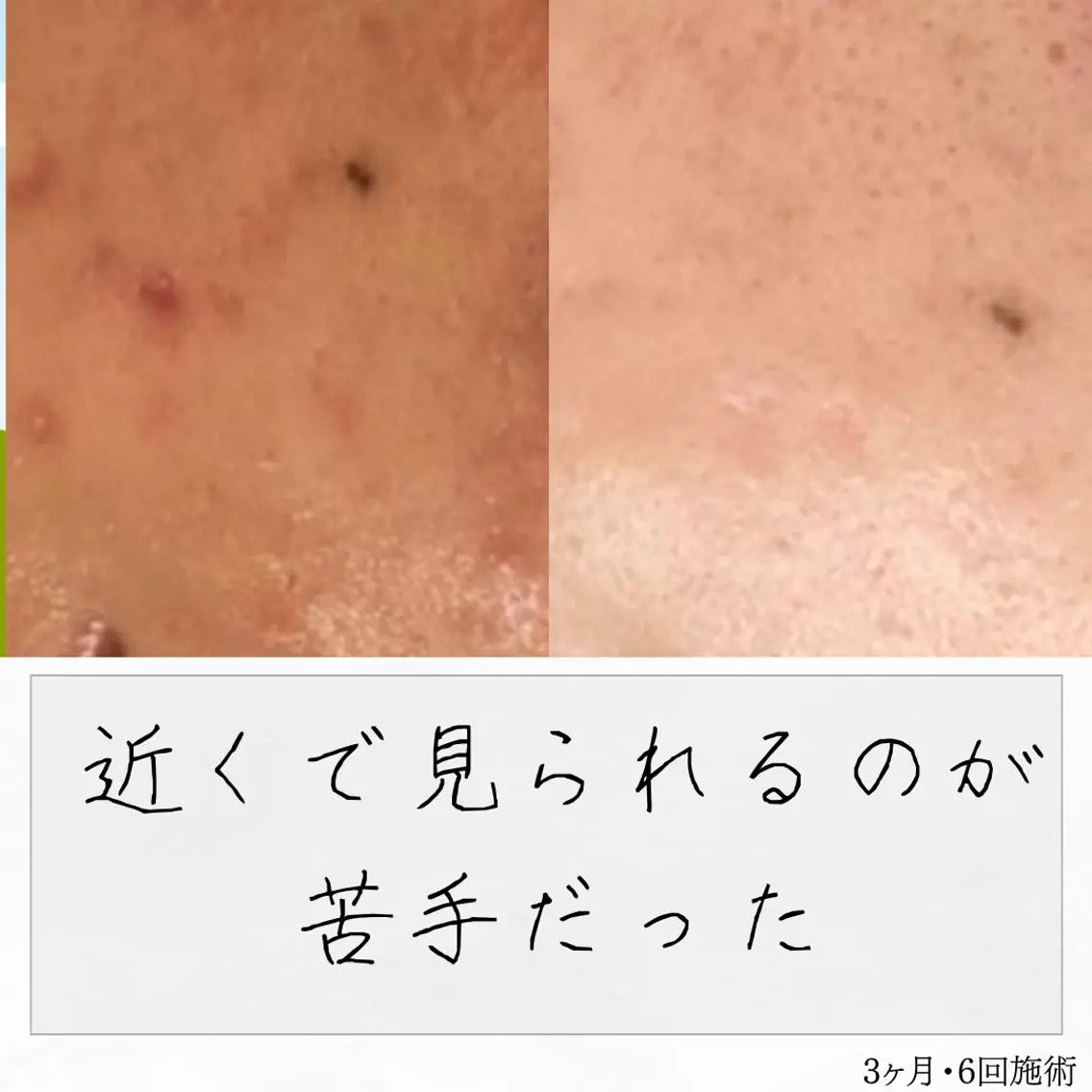 ニキビ経験者が施術 する専門サロン🌻のエステ・リラクイメージ