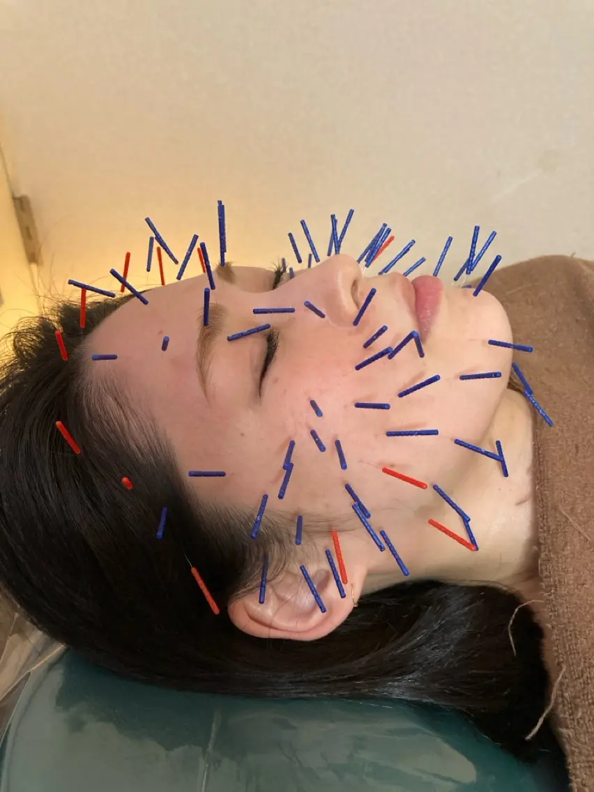 【ミニモ限定割】100本美容鍼+炭酸ヘッドスパ|本格派・肌再生・小顔・リフトアップ☆初回限定の写真