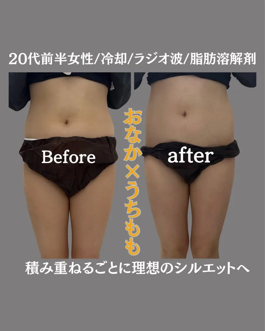 本気で痩せたいお腹【冷却ボディーケア4cup体験コース】 ダイエットサポートクリーム導入で即日効果実感!の写真