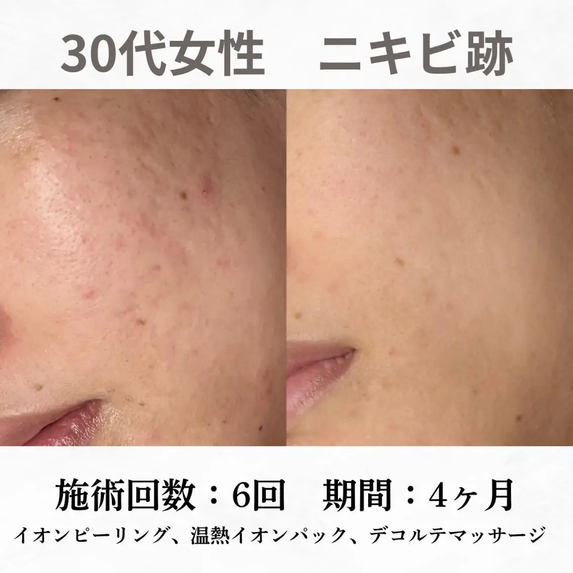 重度ニキビ専門🌷 ダウンタイムなしのエステ・リラクイメージ