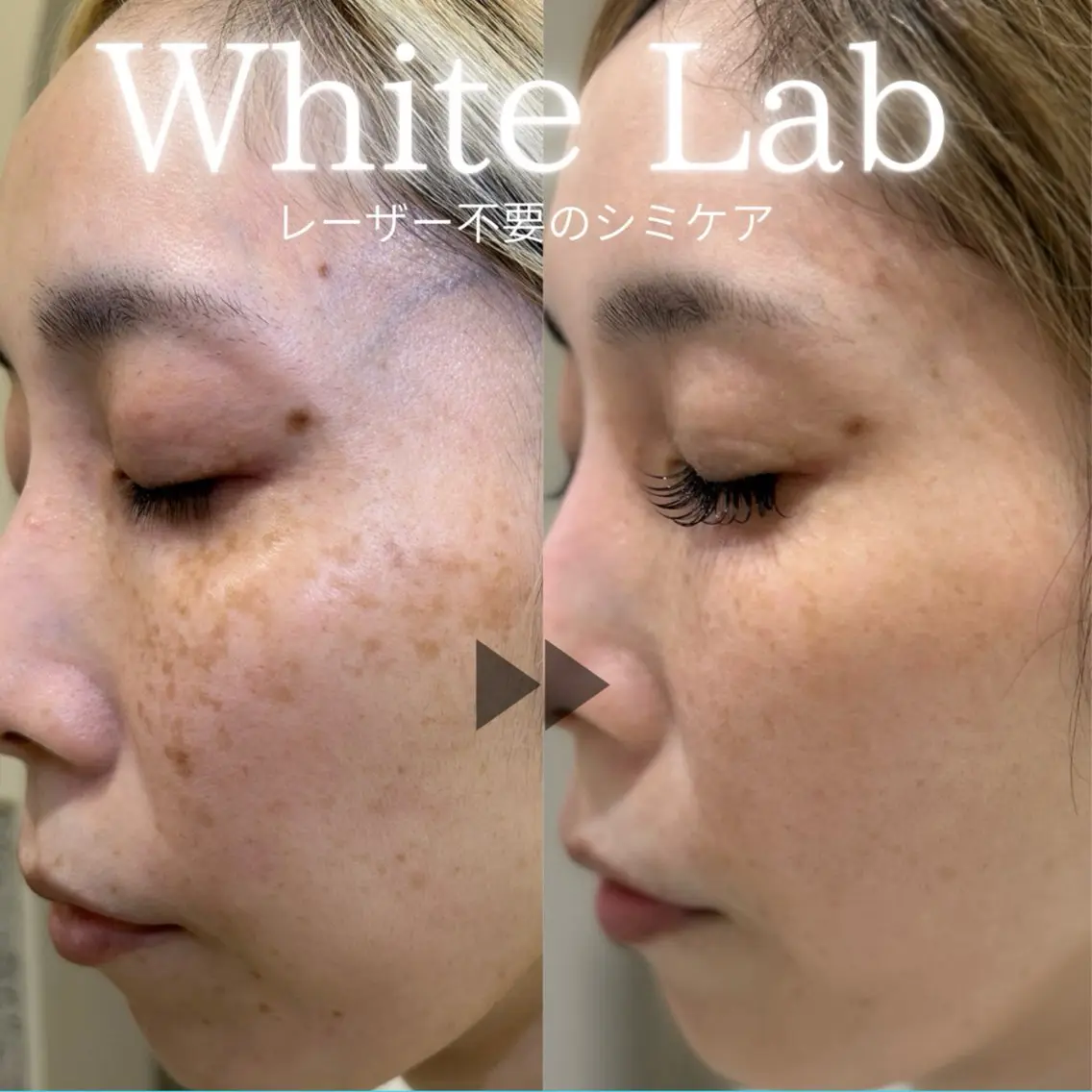 【最新ホワイトラボシミケア】撮影モデル募集(無料)の写真