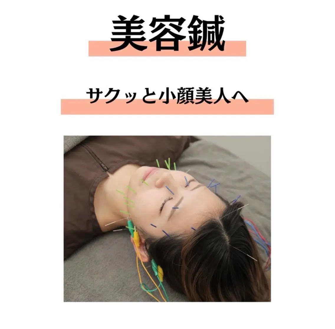 【モデル募集】美容鍼🌿45分 🌟2300円🌟 (口コミ、写真掲載にご協力いただける方)の写真
