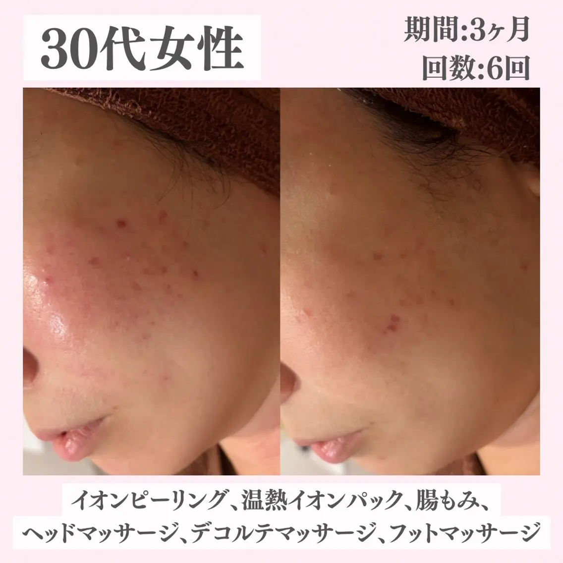 エステ リラク ニキビ・肌質改善専門 ♡人生が変わるサロンのエステ・リラクイメージ